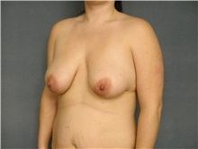 Breast Lift Before Photo by Ellen Janetzke, MD; Bloomfield Hills, MI - Case 25797