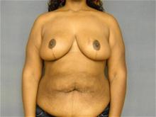 Breast Reduction After Photo by Ellen Janetzke, MD; Bloomfield Hills, MI - Case 25800