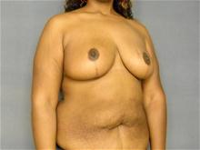 Breast Reduction After Photo by Ellen Janetzke, MD; Bloomfield Hills, MI - Case 25800