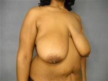 Breast Reduction Before Photo by Ellen Janetzke, MD; Bloomfield Hills, MI - Case 25800