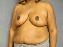 Breast Reduction After Photo by Ellen Janetzke, MD; Bloomfield Hills, MI - Case 25801