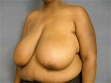 Breast Reduction Before Photo by Ellen Janetzke, MD; Bloomfield Hills, MI - Case 25801