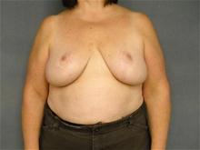 Breast Reduction After Photo by Ellen Janetzke, MD; Bloomfield Hills, MI - Case 25802