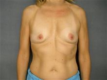 Breast Augmentation Before Photo by Ellen Janetzke, MD; Bloomfield Hills, MI - Case 25803