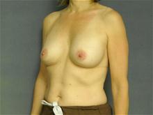 Breast Augmentation After Photo by Ellen Janetzke, MD; Bloomfield Hills, MI - Case 25803