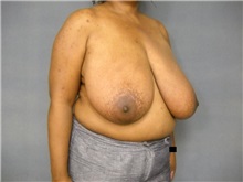 Breast Reduction Before Photo by Ellen Janetzke, MD; Bloomfield Hills, MI - Case 25804