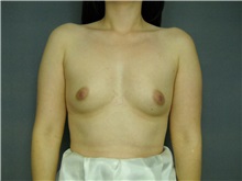 Breast Augmentation Before Photo by Ellen Janetzke, MD; Bloomfield Hills, MI - Case 25805