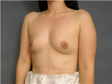 Breast Augmentation Before Photo by Ellen Janetzke, MD; Bloomfield Hills, MI - Case 25805