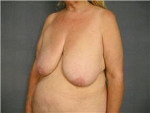 Breast Reduction Before Photo by Ellen Janetzke, MD; Bloomfield Hills, MI - Case 25817