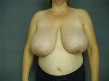 Breast Reduction Before Photo by Ellen Janetzke, MD; Bloomfield Hills, MI - Case 25857