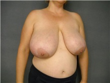 Breast Reduction Before Photo by Ellen Janetzke, MD; Bloomfield Hills, MI - Case 25857
