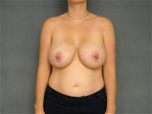 Breast Augmentation After Photo by Ellen Janetzke, MD; Bloomfield Hills, MI - Case 25951