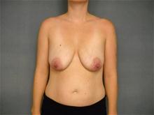 Breast Augmentation Before Photo by Ellen Janetzke, MD; Bloomfield Hills, MI - Case 25951