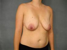 Breast Augmentation Before Photo by Ellen Janetzke, MD; Bloomfield Hills, MI - Case 25951