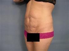 Tummy Tuck Before Photo by Ellen Janetzke, MD; Bloomfield Hills, MI - Case 26011