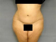 Tummy Tuck After Photo by Ellen Janetzke, MD; Bloomfield Hills, MI - Case 26012