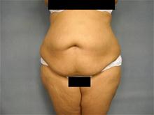 Tummy Tuck Before Photo by Ellen Janetzke, MD; Bloomfield Hills, MI - Case 26012