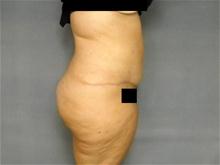 Tummy Tuck After Photo by Ellen Janetzke, MD; Bloomfield Hills, MI - Case 26012