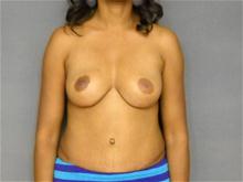 Breast Reduction After Photo by Ellen Janetzke, MD; Bloomfield Hills, MI - Case 26640