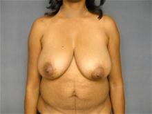 Breast Reduction Before Photo by Ellen Janetzke, MD; Bloomfield Hills, MI - Case 26640