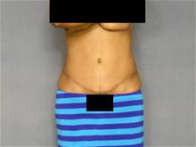 Tummy Tuck After Photo by Ellen Janetzke, MD; Bloomfield Hills, MI - Case 26641