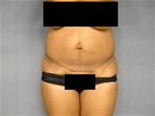 Tummy Tuck Before Photo by Ellen Janetzke, MD; Bloomfield Hills, MI - Case 26641