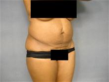 Tummy Tuck Before Photo by Ellen Janetzke, MD; Bloomfield Hills, MI - Case 26641