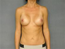 Breast Augmentation After Photo by Ellen Janetzke, MD; Bloomfield Hills, MI - Case 26662