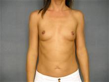 Breast Augmentation Before Photo by Ellen Janetzke, MD; Bloomfield Hills, MI - Case 26662