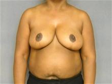 Breast Reduction After Photo by Ellen Janetzke, MD; Bloomfield Hills, MI - Case 26961