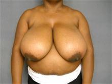 Breast Reduction Before Photo by Ellen Janetzke, MD; Bloomfield Hills, MI - Case 26961