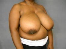 Breast Reduction Before Photo by Ellen Janetzke, MD; Bloomfield Hills, MI - Case 26961