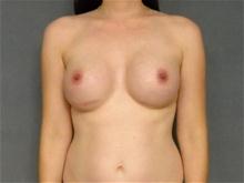 Breast Augmentation After Photo by Ellen Janetzke, MD; Bloomfield Hills, MI - Case 26962