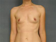 Breast Augmentation Before Photo by Ellen Janetzke, MD; Bloomfield Hills, MI - Case 26962