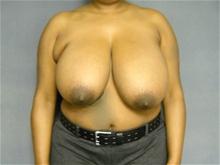 Breast Reduction Before Photo by Ellen Janetzke, MD; Bloomfield Hills, MI - Case 27139