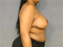 Breast Reduction After Photo by Ellen Janetzke, MD; Bloomfield Hills, MI - Case 27139