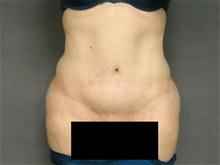 Tummy Tuck After Photo by Ellen Janetzke, MD; Bloomfield Hills, MI - Case 27140