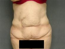 Tummy Tuck Before Photo by Ellen Janetzke, MD; Bloomfield Hills, MI - Case 27140