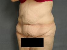 Tummy Tuck Before Photo by Ellen Janetzke, MD; Bloomfield Hills, MI - Case 27140