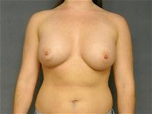 Breast Augmentation After Photo by Ellen Janetzke, MD; Bloomfield Hills, MI - Case 27141