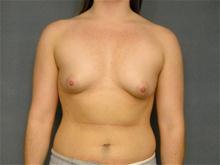 Breast Augmentation Before Photo by Ellen Janetzke, MD; Bloomfield Hills, MI - Case 27141