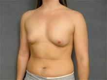 Breast Augmentation Before Photo by Ellen Janetzke, MD; Bloomfield Hills, MI - Case 27141