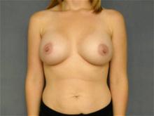 Breast Augmentation After Photo by Ellen Janetzke, MD; Bloomfield Hills, MI - Case 27142