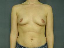 Breast Augmentation Before Photo by Ellen Janetzke, MD; Bloomfield Hills, MI - Case 27142