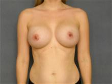 Breast Augmentation After Photo by Ellen Janetzke, MD; Bloomfield Hills, MI - Case 27256