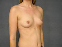 Breast Augmentation Before Photo by Ellen Janetzke, MD; Bloomfield Hills, MI - Case 27256