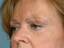 Eyelid Surgery After Photo by Ellen Janetzke, MD; Bloomfield Hills, MI - Case 27259