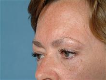 Eyelid Surgery Before Photo by Ellen Janetzke, MD; Bloomfield Hills, MI - Case 27259
