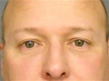 Eyelid Surgery Before Photo by Ellen Janetzke, MD; Bloomfield Hills, MI - Case 27260