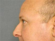 Eyelid Surgery After Photo by Ellen Janetzke, MD; Bloomfield Hills, MI - Case 27260